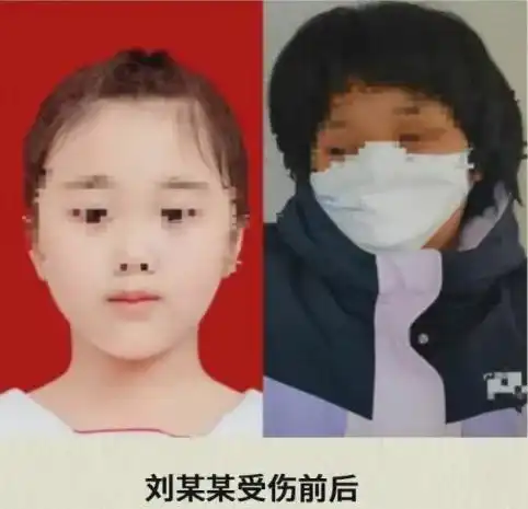 9岁女童被老师三角尺砸碎头骨,一年过去,她怎么样了
