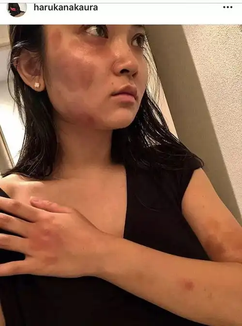 蒋劲夫承认家暴日本女友女方身体大面积淤青令人心疼