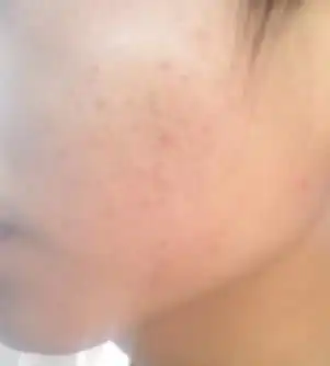 这是粉刺还是黑头有图片