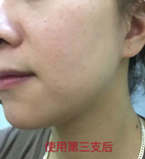 肌肤松弛毛孔粗大不存在的,3支,就能还你一张少女颜