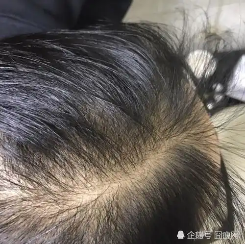 防脱生发洗发水哪个牌子好多人成功的止脱生发了