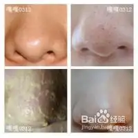 diy祛黑头四大宝典