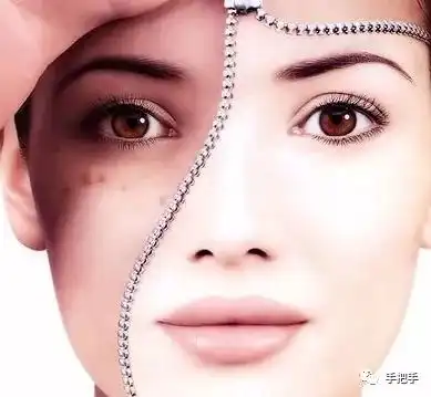 哪些人适合做光子嫩肤手把手