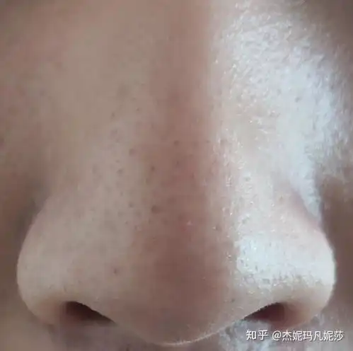 男22,混油皮,有黑头,长痘,貌似还毛孔粗大不求完全修复只求能改善,还有救么orz