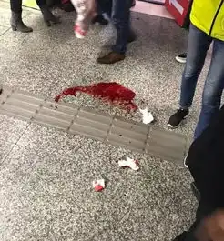 女孩地铁站突然摔下楼梯,满脸是血,嘴巴缝针这个习惯害了她