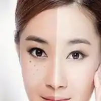先给大家上一些我第一次做祛褐青色痣图片,虽然只有大...去痣悦美整形