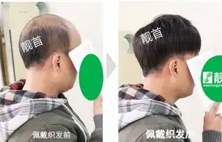 中年男士男人假发套头顶稀少实拍案例