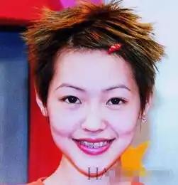 牙套原来可以改变脸型徐娇小s岳云鹏都戴过,baby变化最大