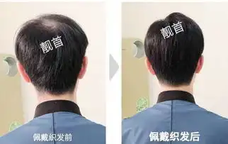 中年男士中老年男士假发套发际线高实拍案例