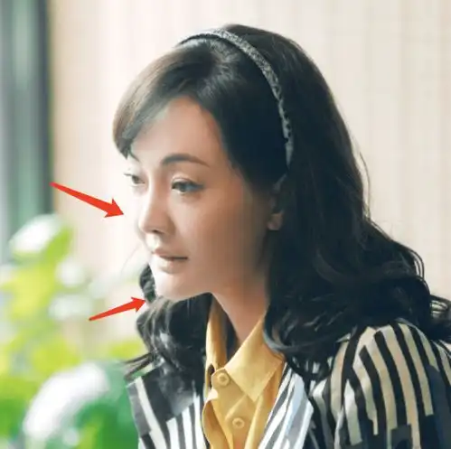 鼻长脸尖肿成发面团,中老年女星动脸简直是重灾区
