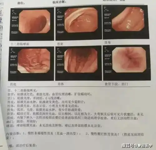 做胃镜真的只是查胃吗一组图片告诉你胃镜多厉害值得收藏