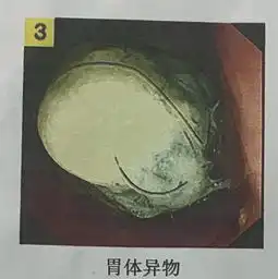 南宁5岁女孩爱吃头发,致腹痛1年多医生异食癖
