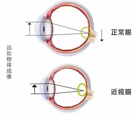 女孩3岁戴眼镜5岁近视300度除了看电视玩ipad,这个重要原因家长忽视了...