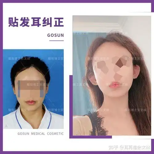 贴发耳显脸大小姐姐做了赵丽颖同款耳朵后脸也变小了