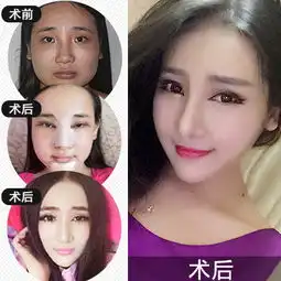 美颜套餐芭比v脸美眼综合2项翘鼻综合3项隆下巴瞬变女神等你来变美悦美整形