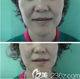 锦州富来慕光纤热塑让你从此告别双下巴附真人案例