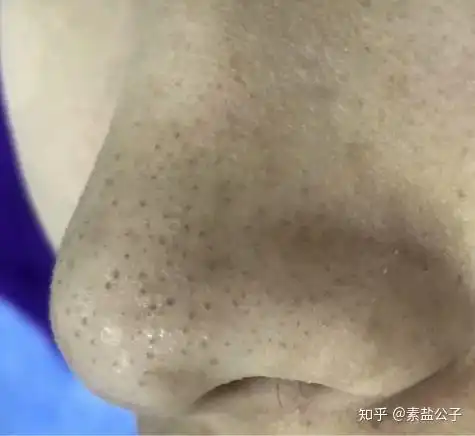 求去黑头的正确方法