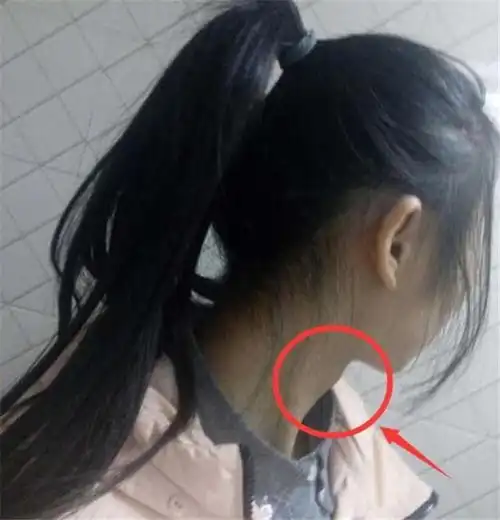 13岁女孩长出喉结胡子,医生这些零食,别再买给孩子吃了
