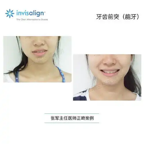 西安牙齿矫正张军爱笑的女孩最自信