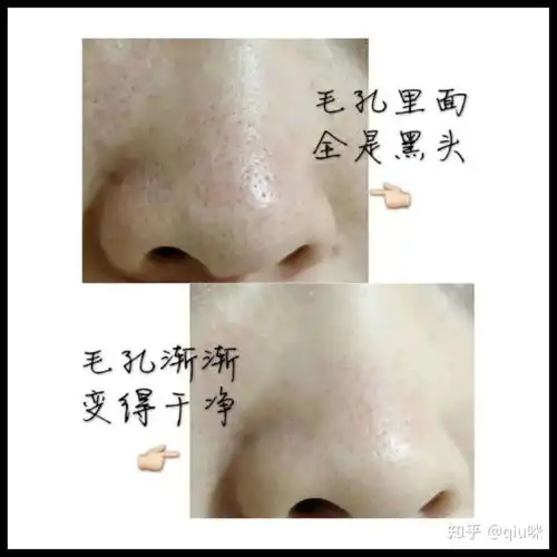 黑头反反复复去不掉,怎么办