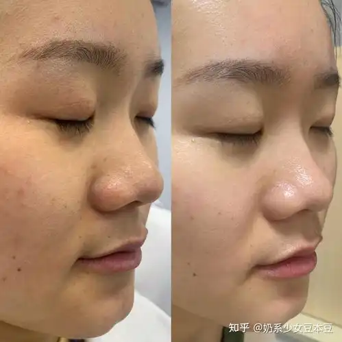18岁左右的女生如何趁暑假把皮肤养好