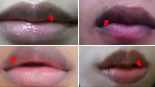 爱美女孩注意了经常涂劣质口红,可能会烂嘴唇