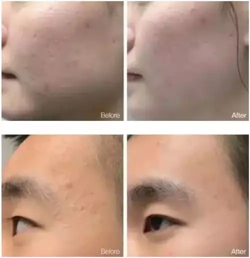 如何成为皇上心头的无黑头白月光女孩
