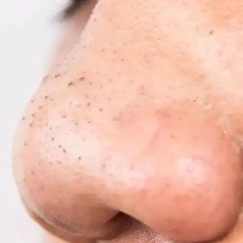 粗盐黑头贴不去黑头,真正有效的办法看这一个