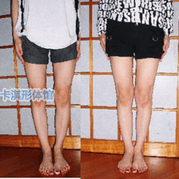 天津形体o型腿x型腿一对一矫正一对一电话咨询费用卡淇形体馆