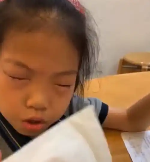 9岁女孩一做数学题就过敏,眼睛肿胀狂冒疙瘩,网友评论亮了