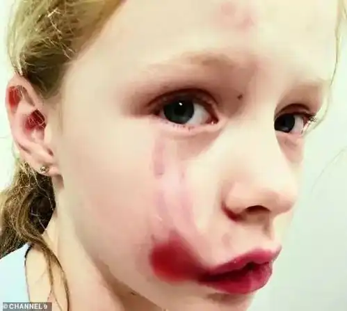 昆州女童被邻家恶犬咬到血肉模糊,母亲哭诉肉都被咬掉一块