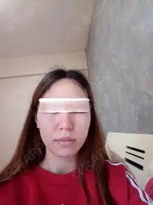我从小眼睛就很小,纯单眼皮...眼综合悦美整形