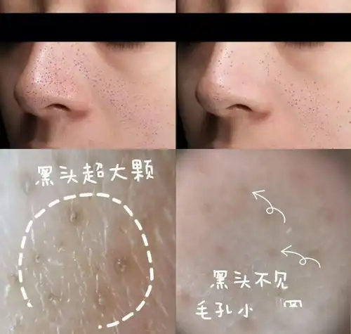 黑头挤1颗留1个洞快来学这招,鼻子滑溜到男朋友想蹭