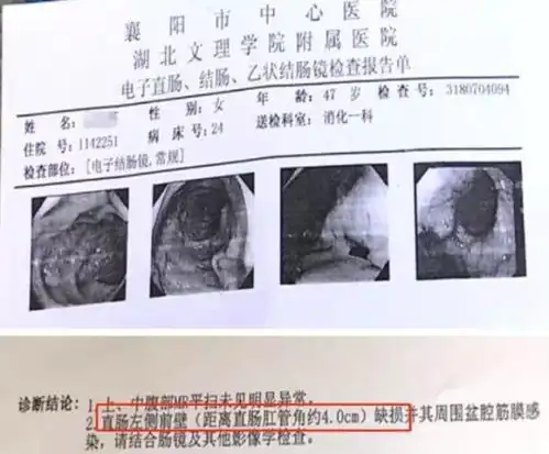 惊襄阳女子做肠疗,肠道被戳出一个洞
