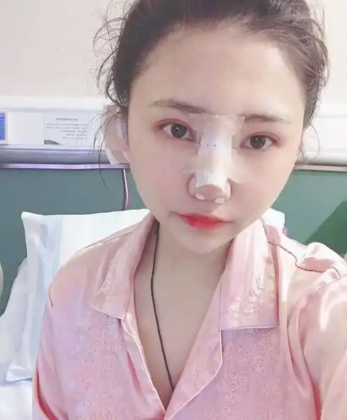 女人隆鼻后差距到底有多大术后回家爸妈都认不出来,太成功了吧