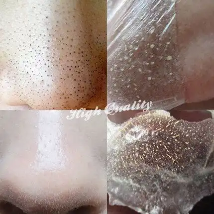 去黑头套装吸黑头粉刺收缩毛孔祛螨虫鼻贴膜t区男女花之泪正品
