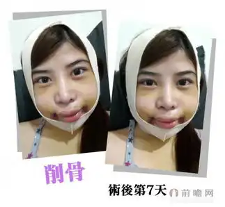 台湾女子自曝削骨变小脸全过程画面惊心网友疯狂点赞