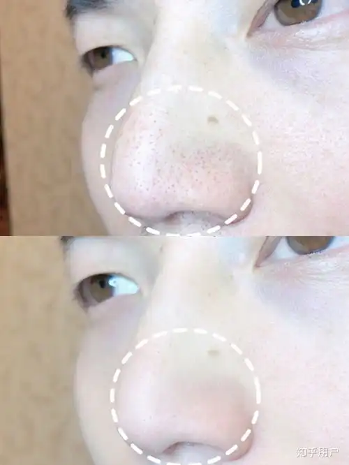 男生怎么有效的去除黑头