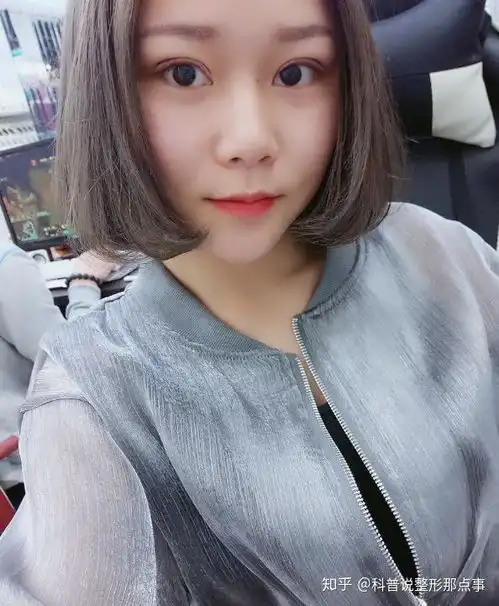 单眼皮女生1个月蜕变割双眼皮眼综合后两眼放光迷倒无数少男