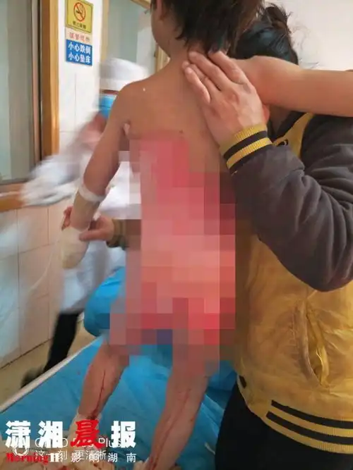 男孩被开水烫伤搬砖父母没钱住院商量提前回家