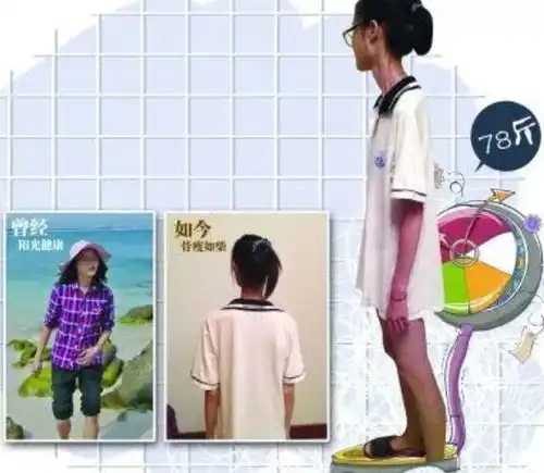 90后女生节食减肥失控,变成瘦竹竿,如今却要花40万增肥