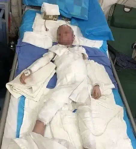 热水器爆炸,一家三口95以上烧伤使用热水器,千万注意这4点