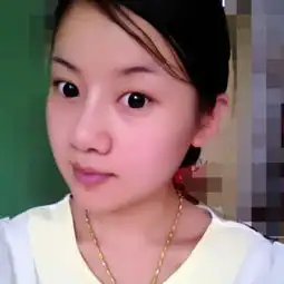 婴儿肥做了面部吸脂,恢复过程图奉上