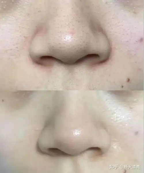 连续做一年医美,黑头真的能彻底去除嘛