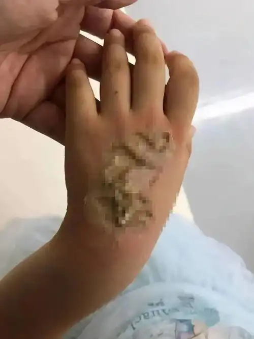 触目惊心电话手表自燃致4岁女童手背严重烧伤