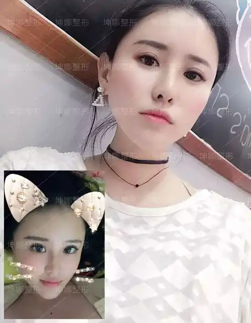 哇,这样的脸蛋填了脂肪,100变少女心形脸