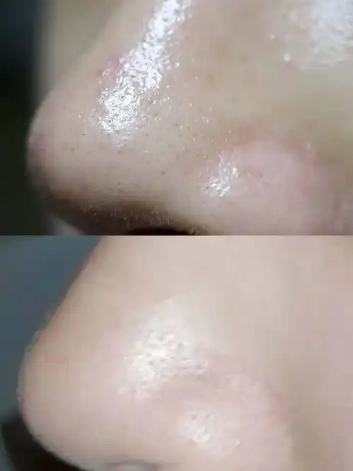 养出男神狗子都夸的好皮肤以前满鼻子黑头