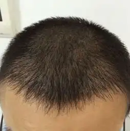 南昌植发效果最真实分享
